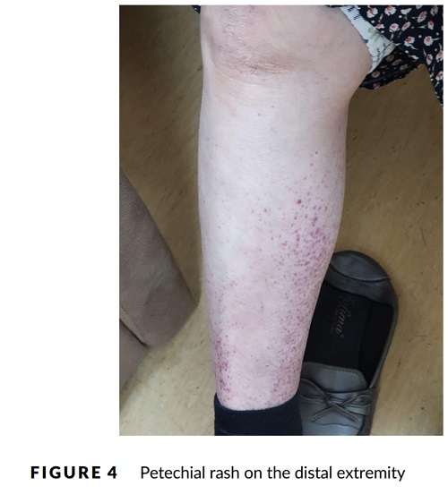 コロナウイルスの下肢点状出血斑.jpg