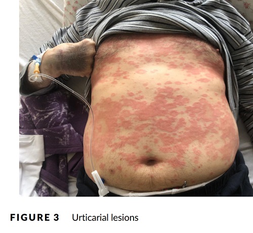 コロナウイルスの蕁麻疹.jpg