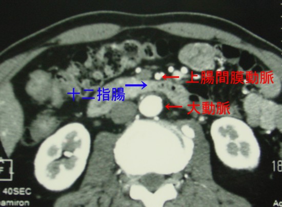 上腸間膜動脈症候群CT1.jpg