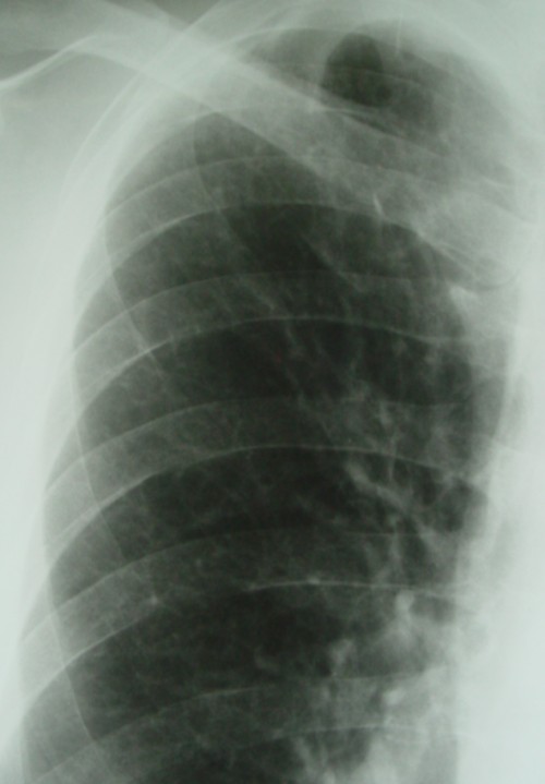 肺癌右肺尖レントゲン1.jpg