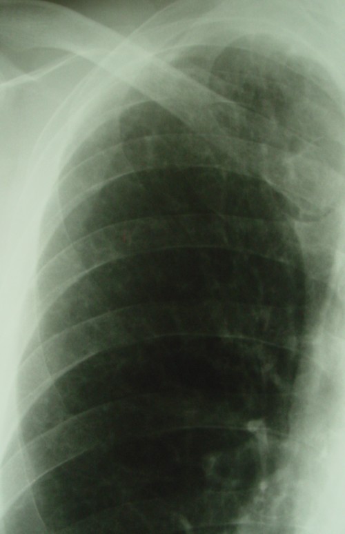 肺癌右肺尖レントゲン2.jpg