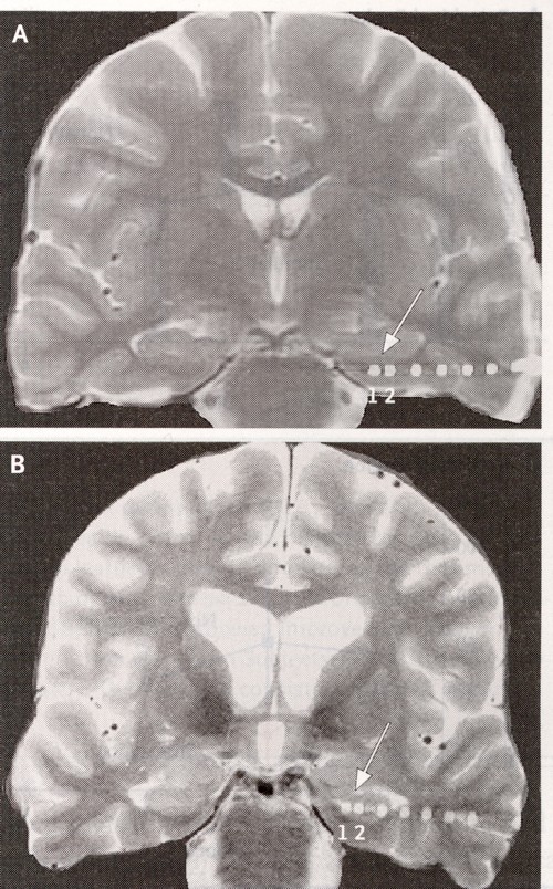 脳の刺激部位のMRI.jpg