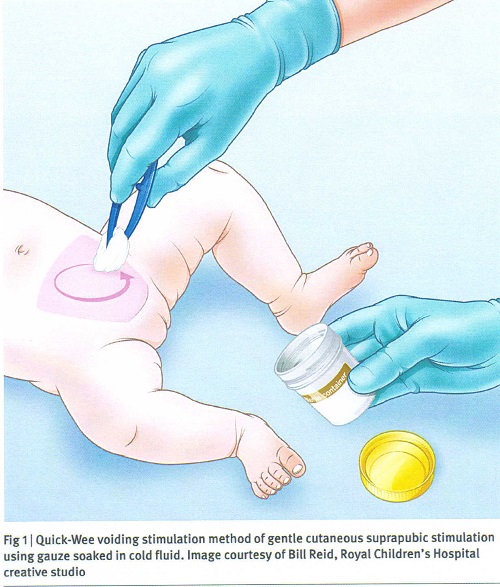 赤ちゃんの尿採取法の図.jpg
